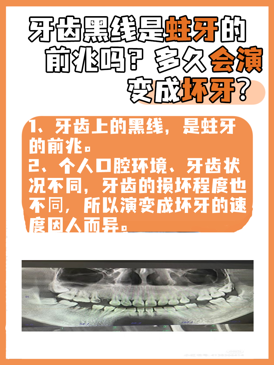 牙齿黑线是蛀牙的前兆吗？多久会演变成坏牙？