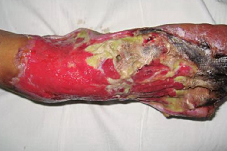 坏死性筋膜炎脚背症状图