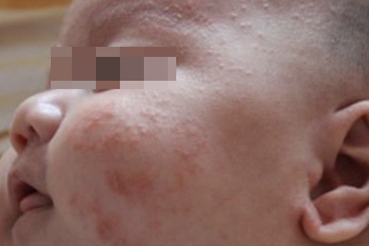 渗出型婴儿湿疹面部出现红点图 渗出型婴儿湿疹面部出现红点图