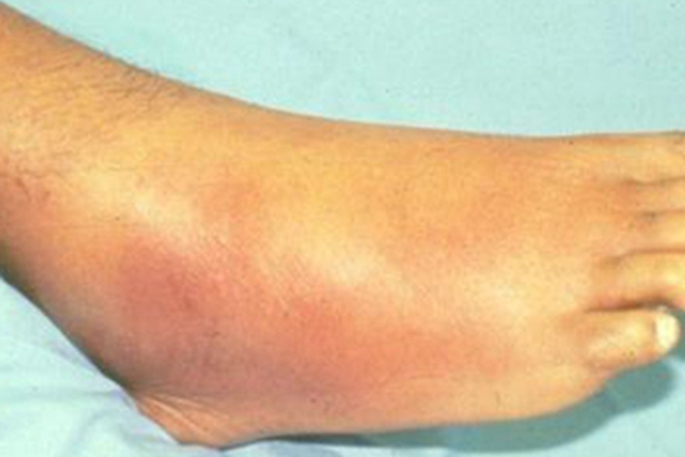 急性期硬化性脂膜炎脚部症状图