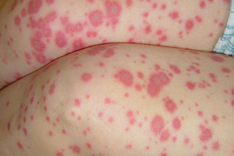 川崎病复发红疹图