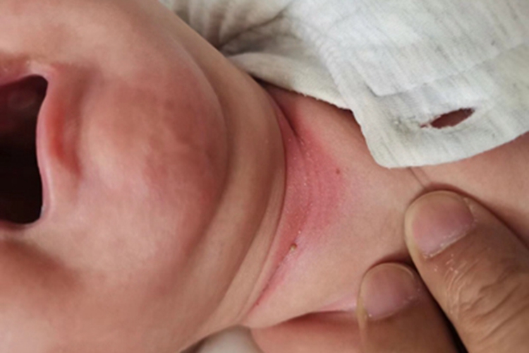 间擦疹前颈红斑图