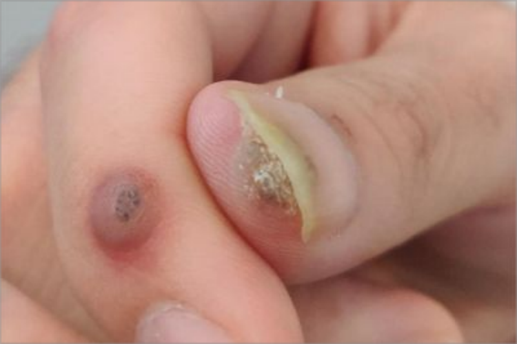 寻常疣手指甲小疙瘩图
