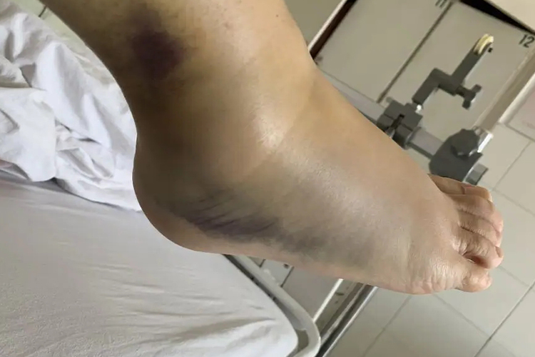 闭合性骨折图