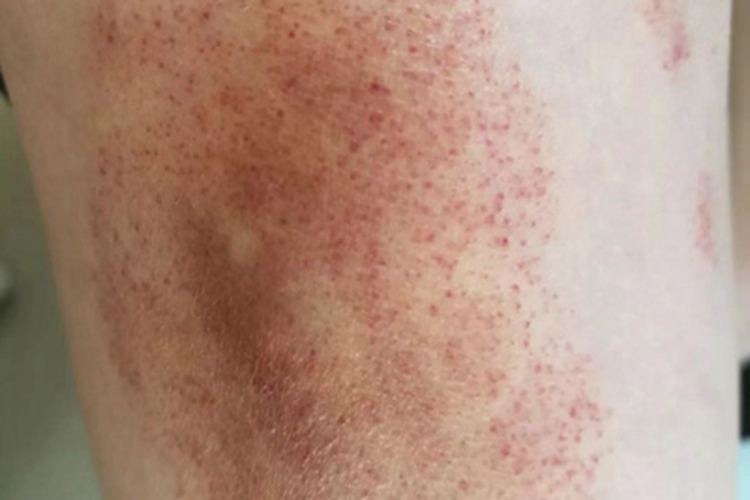 色素性紫癜性苔藓样皮炎斑图 色素性紫癜性苔藓样皮炎斑图