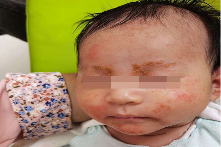 脾虚湿蕴宝宝热毒疹图