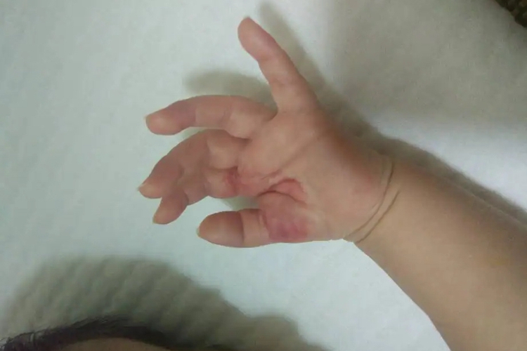 外伤手上有红色瘀血图