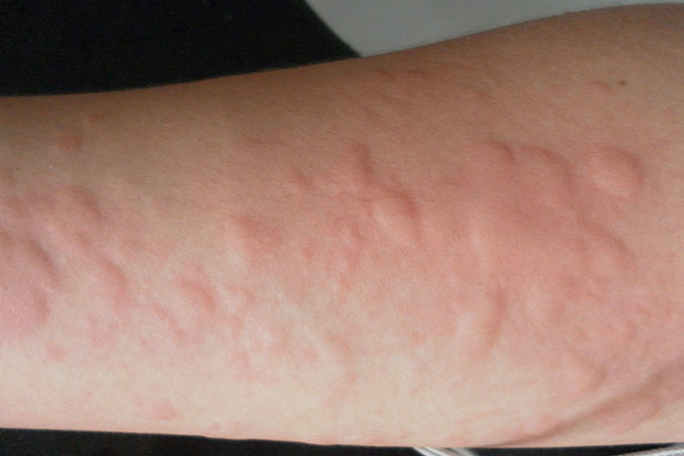 吃海鲜过敏起疙瘩图