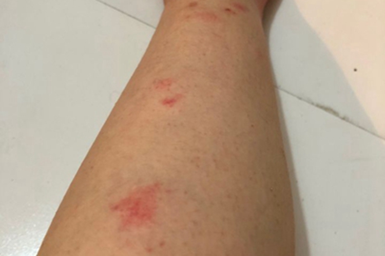 跳蚤叮咬小腿长红斑图