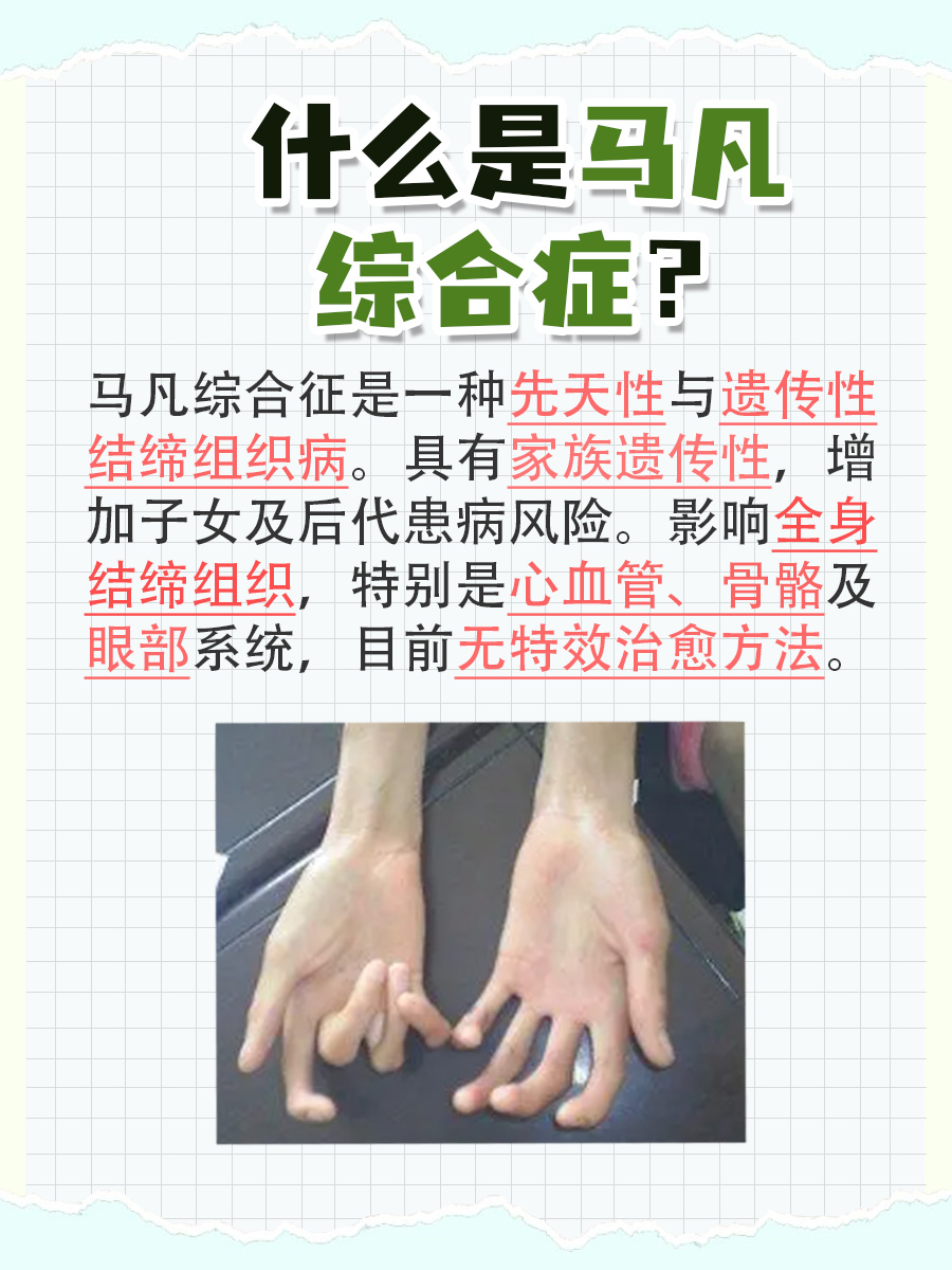 带你了解：马凡综合征是什么？