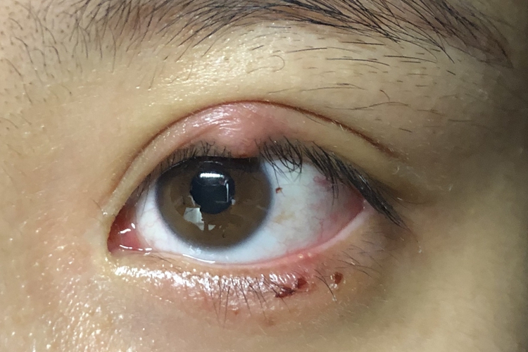 内眼角上方眼皮处有凸起可由霰粒肿,麦粒肿引起.具体情况如下:症状内