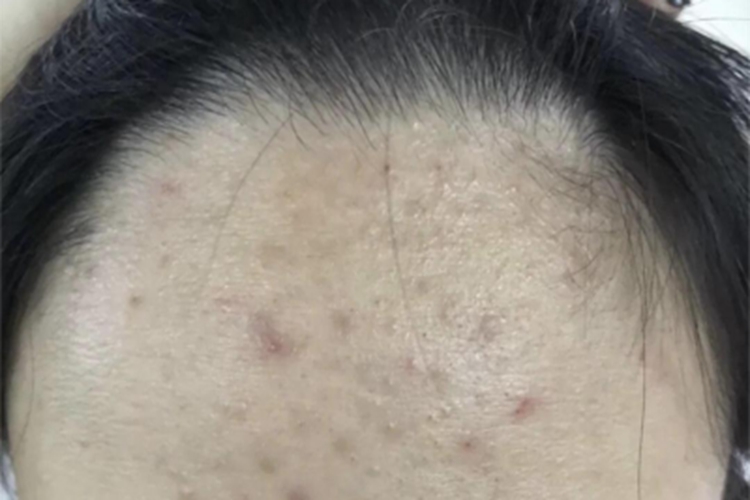 暴发性玫瑰痤疮前额疙瘩图 暴发性玫瑰痤疮前额疙瘩图