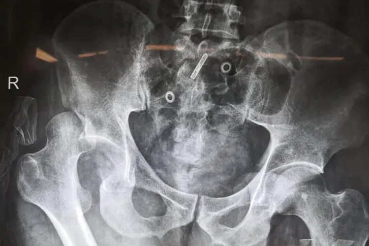 髋关节后脱位图