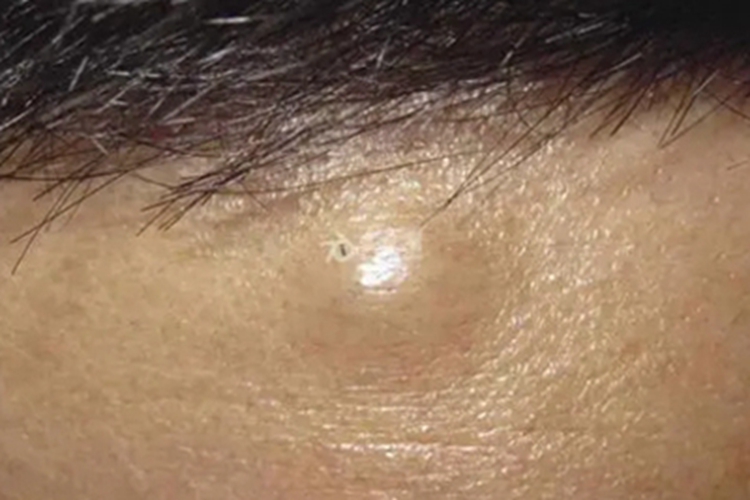 孤立性毛发上皮瘤症状图