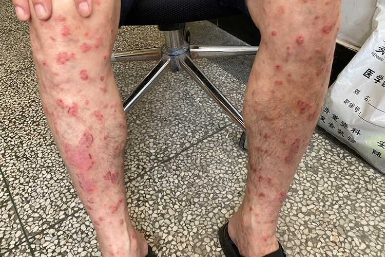 多形性红斑图新冠即新型冠状病毒,感染后皮疹呈多样性,可有斑丘疹,荨