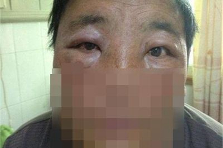 皮肤炭疽眼周肿胀图