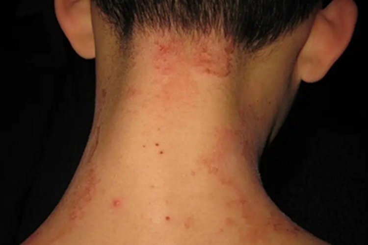 远心性环状红斑后颈症状图