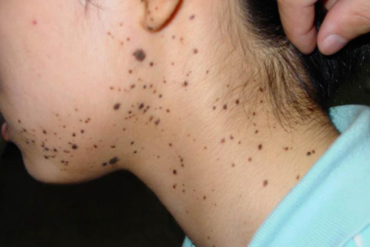 脖子色素痣图 脖子色素痣图