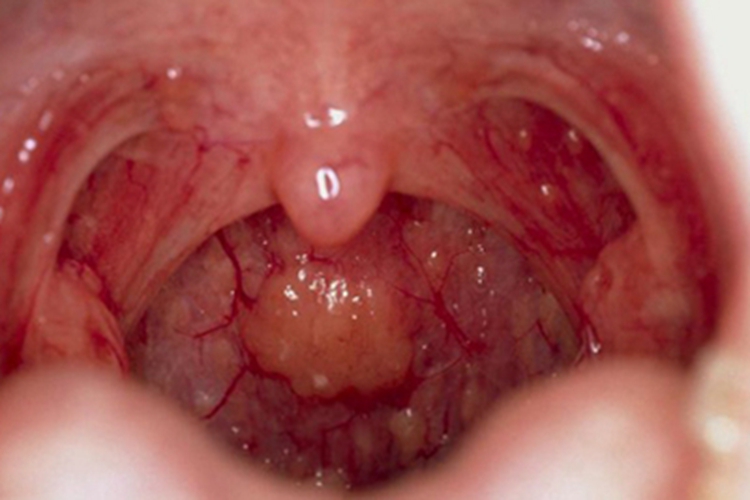 慢性咽炎咽喉包块图
