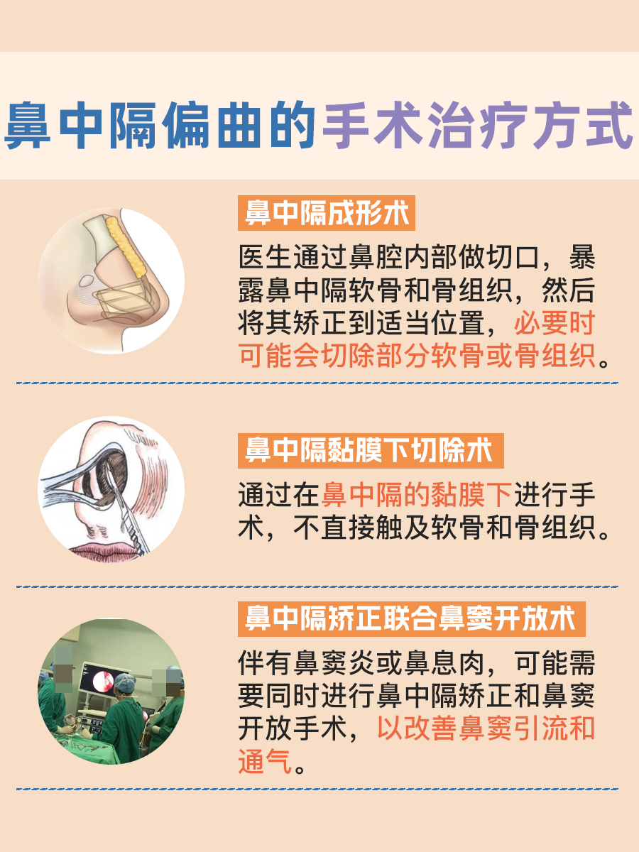 专业医生解析：鼻中隔偏曲一定要手术吗？