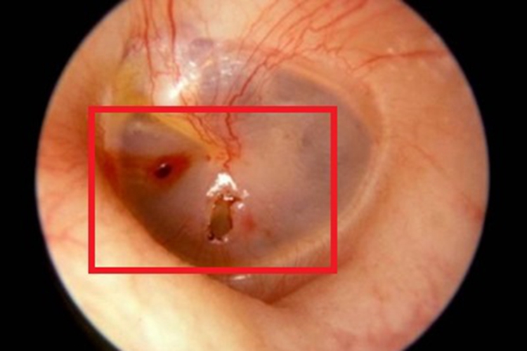 急性化脓性中耳炎孔图 急性化脓性中耳炎孔图
