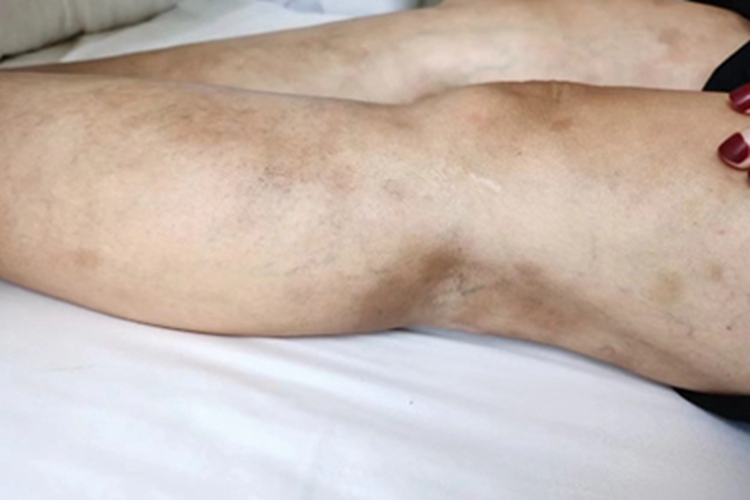 系统性硬皮病斑图