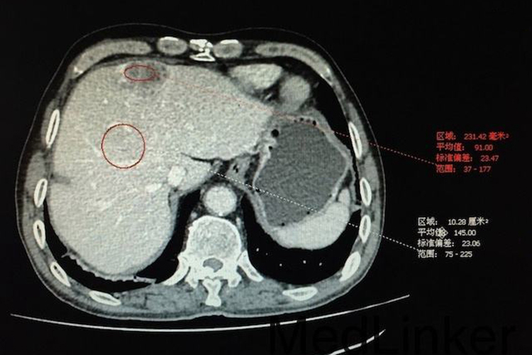 肝癌CT图