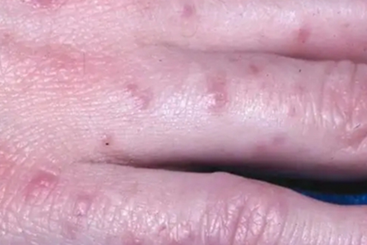 结痂性疥疮疙瘩图 结痂性疥疮疙瘩图