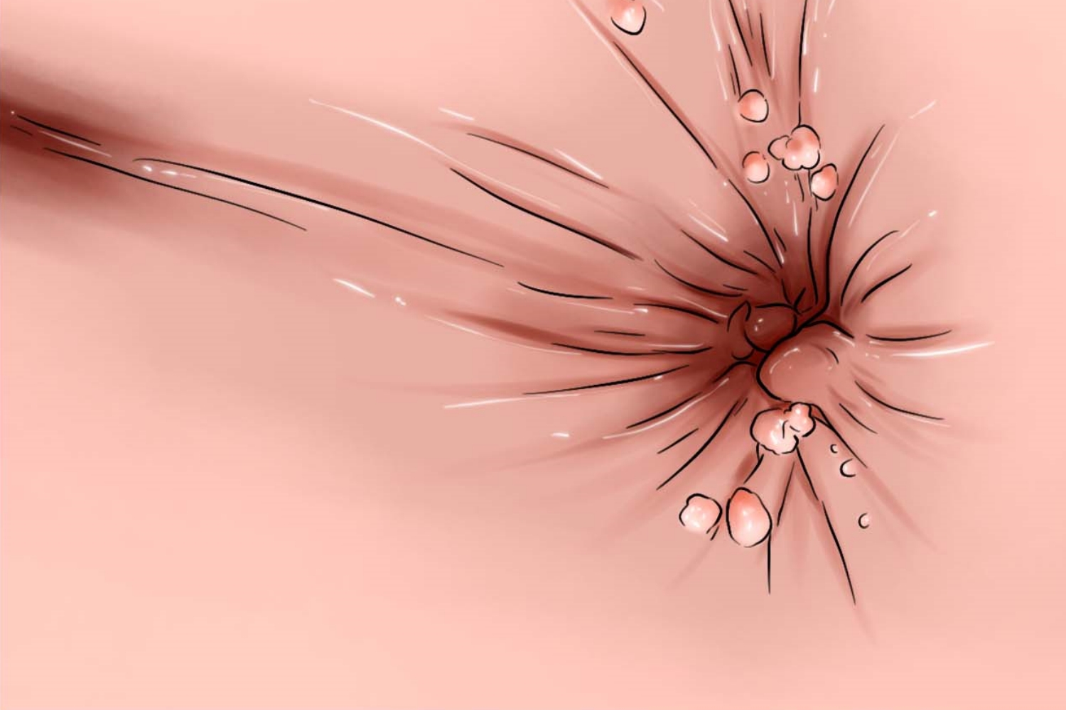 尖锐湿疣图 尖锐湿疣图