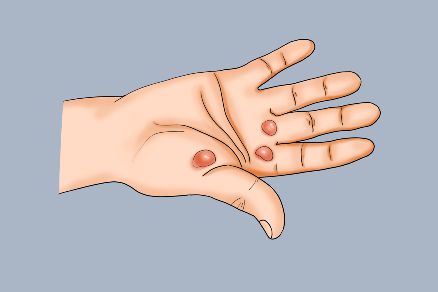 手部屈指肌腱腱鞘炎位置图