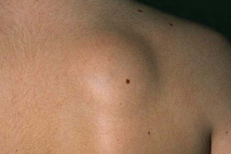 皮脂腺囊肿背部症状图