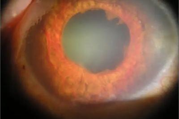 新生血管性青光眼前期眼球红斑图