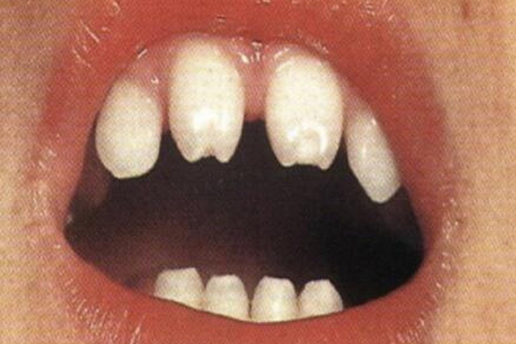 梅毒半月形切牙图