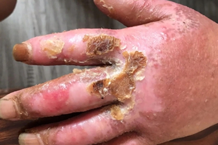 电烧伤手背症状图 电烧伤手背症状图