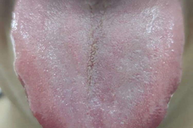 阳虚体质舌苔图