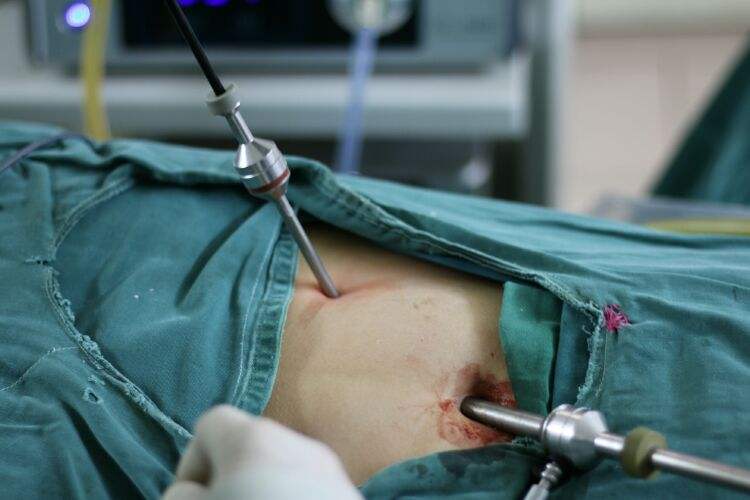 腹腔镜阑尾切除术图