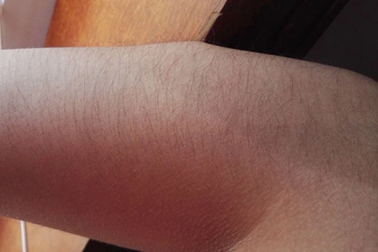 女性多毛症胳膊上长很多毛发图