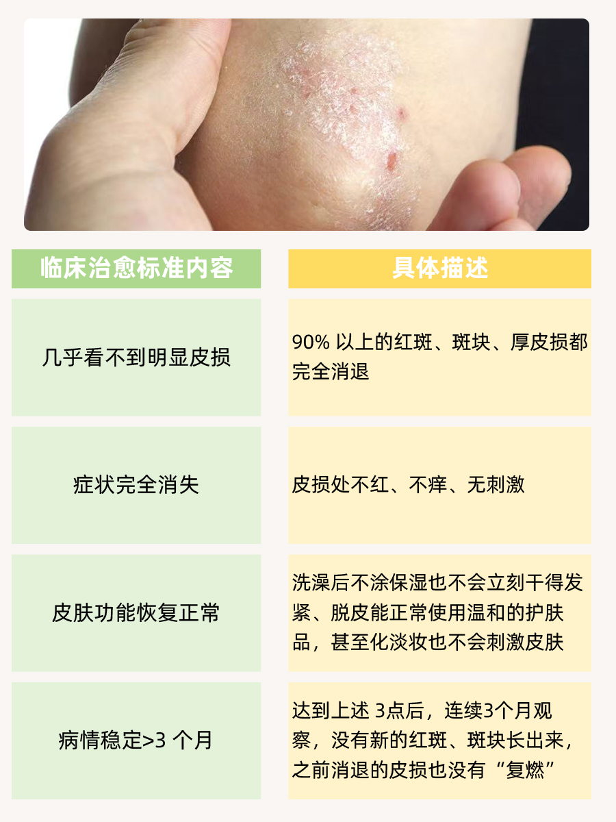 银屑病能治好吗,揭秘“根治”真相!速戳!