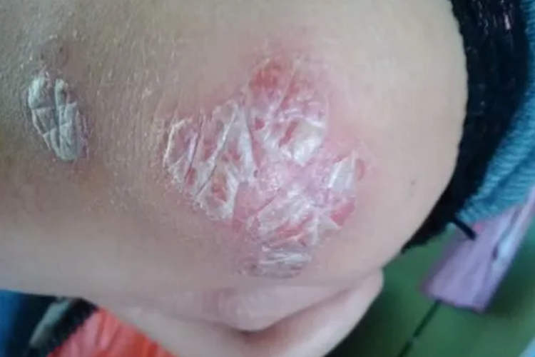 胳膊肘银屑病图