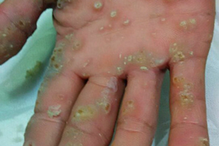 职业性疣赘手掌结节图