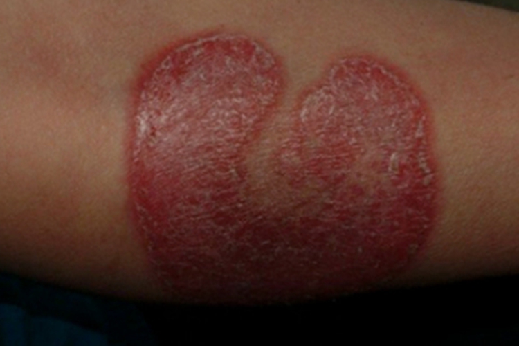 蕈样肉芽肿脱屑图