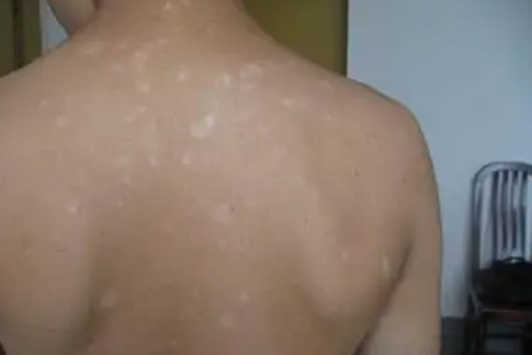 白癜风后背白斑图