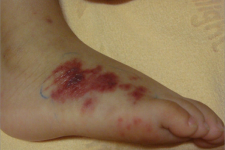 暴发性紫癜脚部瘀斑水疱图