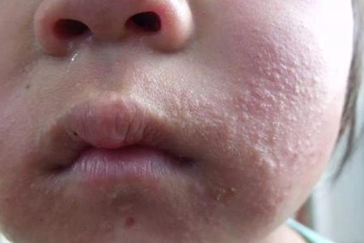 芒果过敏症状图片