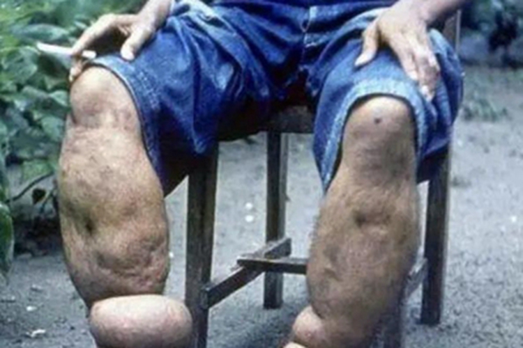 丝虫性淋巴水肿小腿皮肤粗糙图