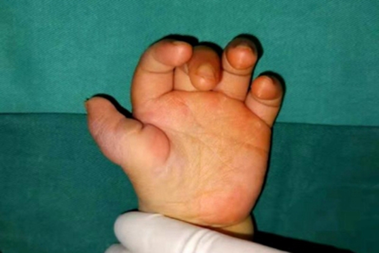 软骨发育不全手部畸形图