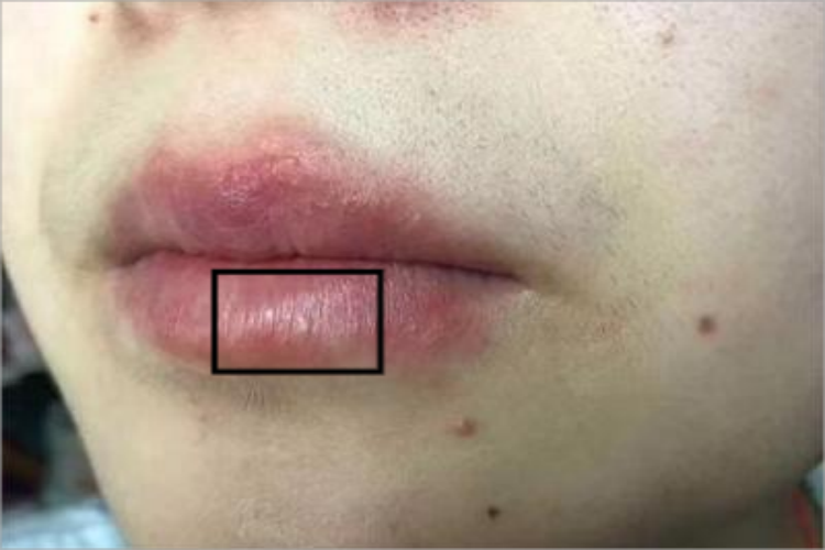 急性光化性唇炎小水疱图