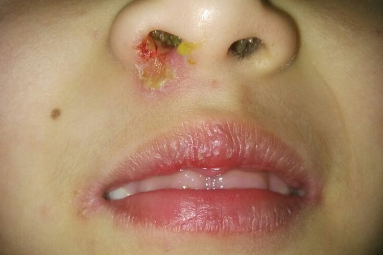 儿童鼻腔糜烂的症状图