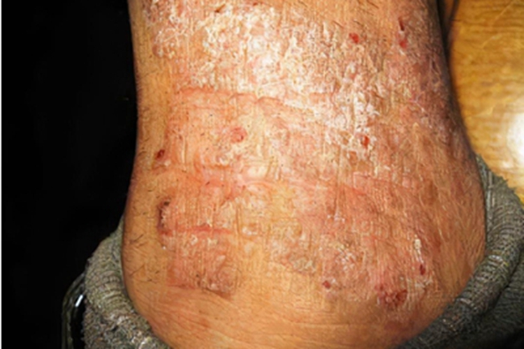 急性湿疹脚踝结节图 急性湿疹脚踝结节图