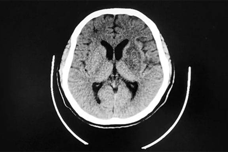 CT扫描示低密度脑梗病灶图